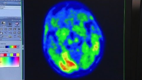 Tau and Alzheimer