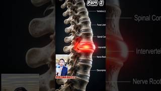 Herniated Disc #physiotherapy#HerniatedDisc#SpineHealth#Physiotherapy#BackPainRelief#DrUsmanBhatti