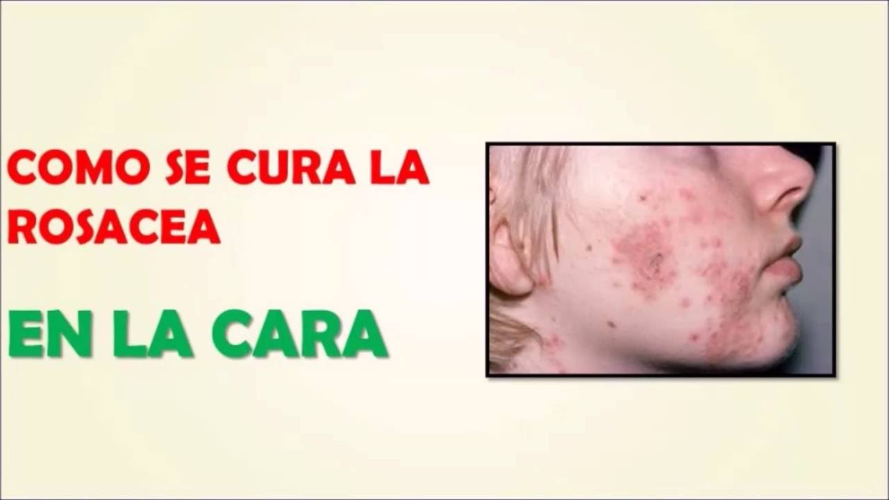 COMO SE CURA LA ROSACEA EN LA CARA DESCUBRE CÓMO SE CURA LA ROSACEA