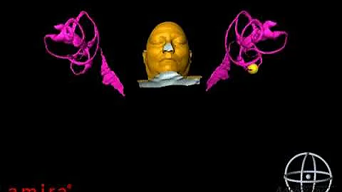 Brandt-Daroff Exercises for Left Posterior Canal BPPV