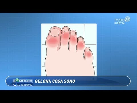 Il Mio Medico - Geloni: cosa sono