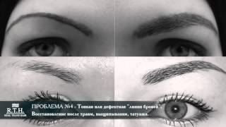 Пересадка волос для женщин. Клиника Real Trans Hair Пересадка волос для женщин. Клиника Real Trans Hair