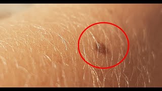 國人皮膚癌人數暴增10倍!黑痣、黑色素瘤傻傻分不清?學會這5招,讓您簡單判別! | 新闻24小时