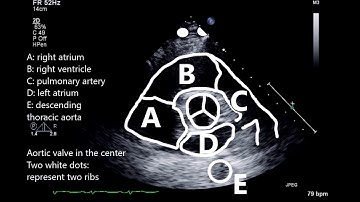 Parasternal short axis view at the level of the aortic valve
