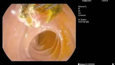 Удаление камней из желчных протоков. ЭРХПГ.