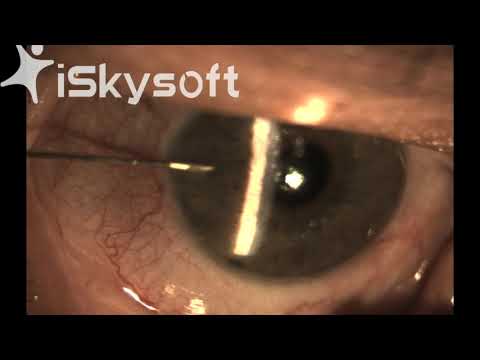 Management of Acute Angle Closure Glaucoma