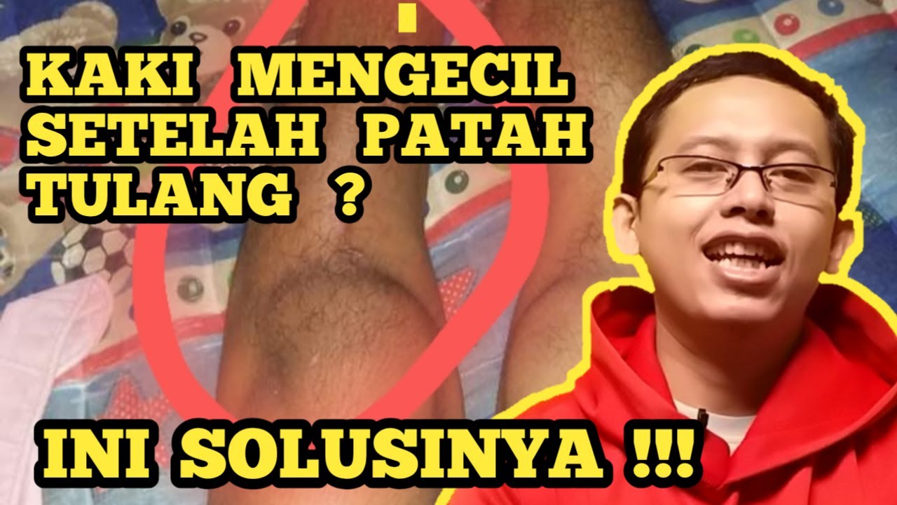 KAKI KECIL SEBELAH AKIBAT PATAH TULANG, CARA MEMBESARKAN OTOT BETIS