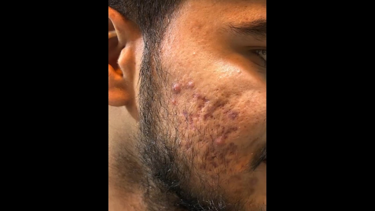 Carbon Laser Treatment for Pimples | Full Procedure + Shocking Before & After! #acne #acnetreatment
