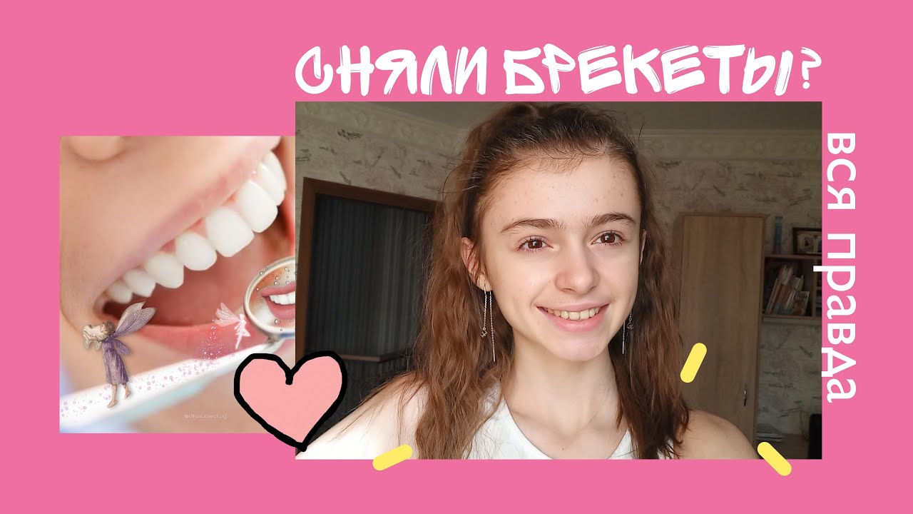 МНЕ СНЯЛИ БРЕКЕТЫ | ВСЯ ПРАВДА О БРЕКЕТАХ - YouTube