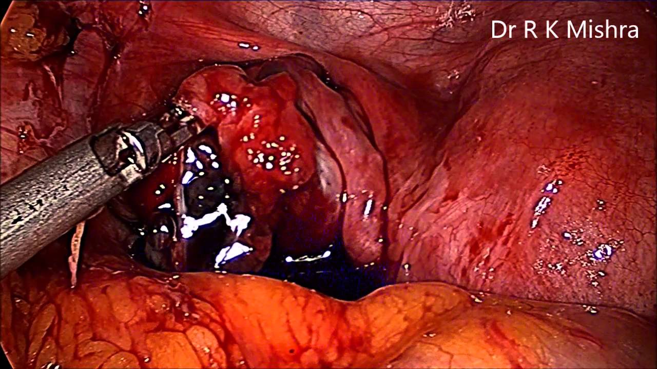 Laparoscopic Excision of Endometriosis