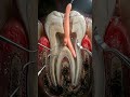 What Dentists Actually Do Inside Your Tooth 😱 #RootCanal #Dentistry