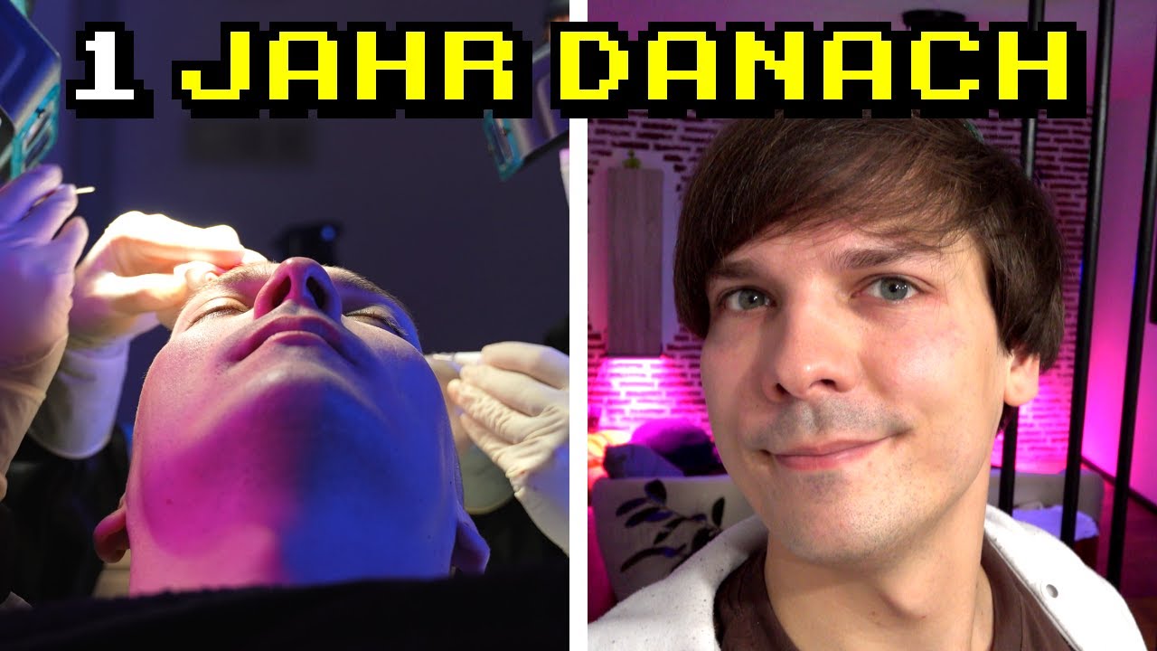 Wie sieht eine Haartransplantation ein Jahr später aus?