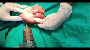 1st Metacarpal base fracture | Percutaneous K-wire fixation | Closed reduction | Adamya hospital vid
