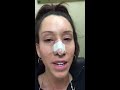 22 hours after rhinoplasty,septoplasty,sinus surgery and looking good