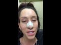 22 hours after rhinoplasty,septoplasty,sinus surgery and looking good
