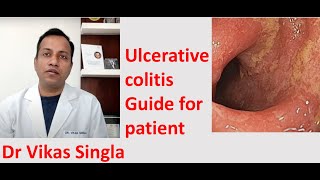 Ulcerative colitis:  Treatment and Symptoms (अल्सरेटिव कोलाइटिस), In Hindi Dr Vikas Singla