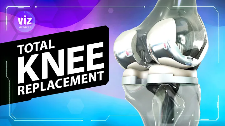 Total Knee Replacement Explained in 1 Minute (3D Animation!)