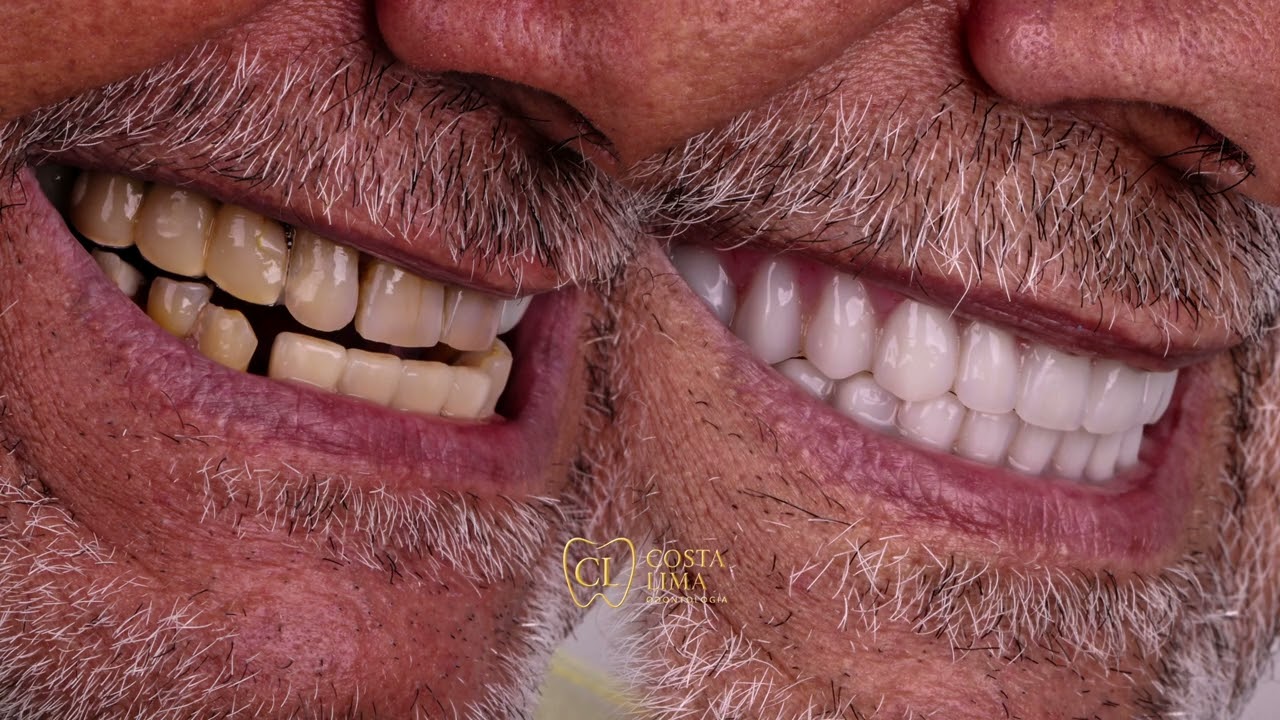 Antes e Depois do Implante Dentário Protocolo | Sorriso Transformado em Madureira RJ