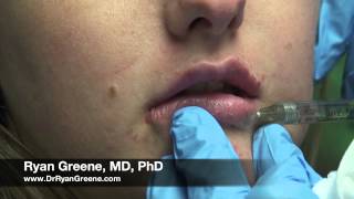 Juvederm Lip Augmentation in South Florida - Dr. Ryan Greene