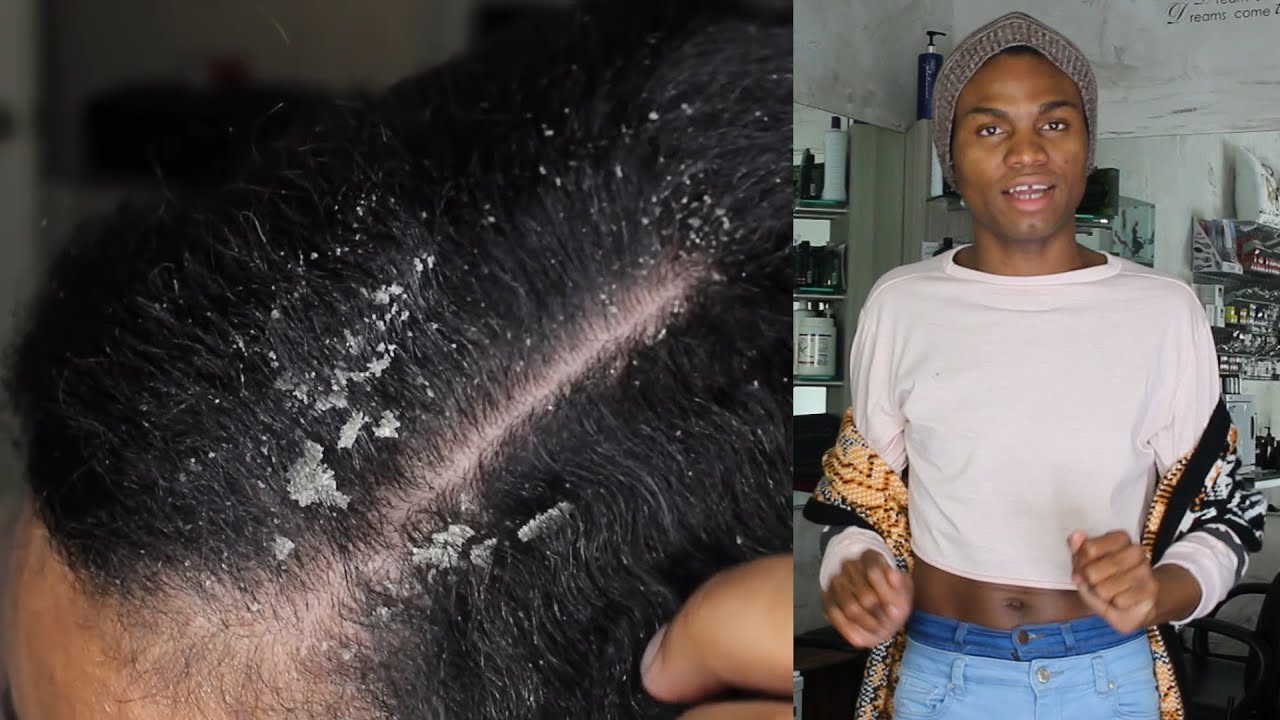 HAIRDRESSER REACTS TO SCRATCH MY DANDRUFF ASMR 😲🔥🔮☎ YouTube