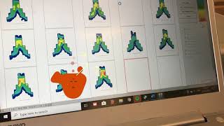 Saddle Pressure Mapping in Physio Bike Fitting