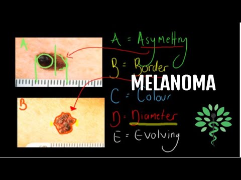 Video: Tatu Amalgam: Adakah Melanoma? Diagnosis Dan Rawatan Plus