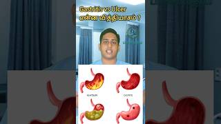 அல்சர்- இரைப்பை அழற்சி என்ன வித்தியாசம்|Gastritis vs Ulcer difference|Pangastritis|ulcer gastritis