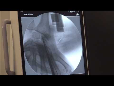Vidéo: La fracture du scaphoïde guérit-elle ?