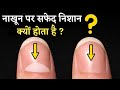 आपके नाखूनों पर निशान आपके आने वाले कल का भविष्य बताते हैं