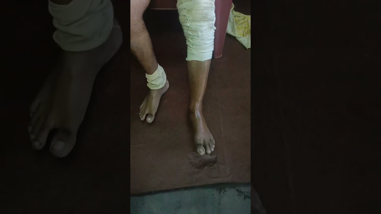 Knee ligament tare treatment at Gokul yelumbu Murivu vaithiya Salai Namakkal town bus staand