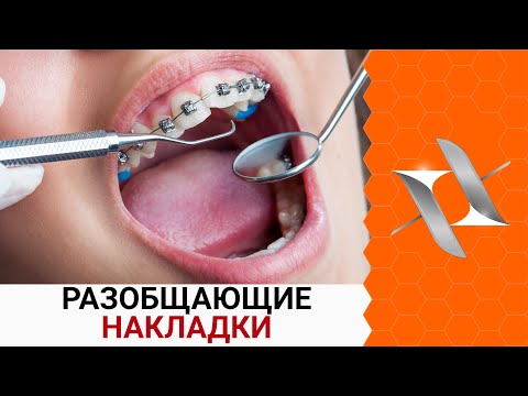 НАКЛАДКИ с брекетами | Самое страшное в ортодонтии