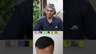 Class 3 Baldness Transformation | Natural Hair Transplant Results Explained by Dr  Sreedhar Reddy