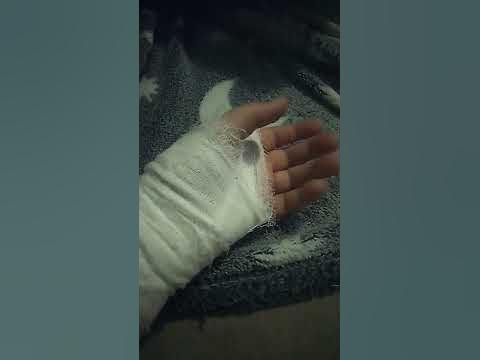 у меня сломана рука - YouTube