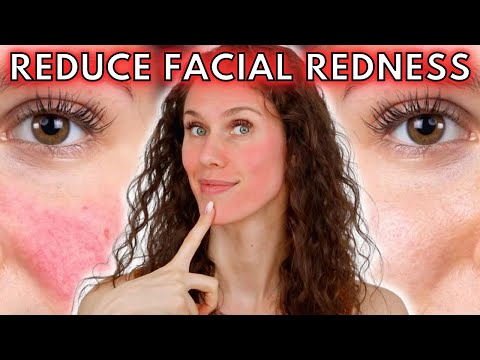 🔴 5 Reasons Your Face Is Always Red (Rosacea to Dermatographia & Everything In-between!)