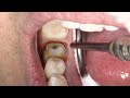 How to Remove a Retraction Cord BEFORE  Intraoral Scan