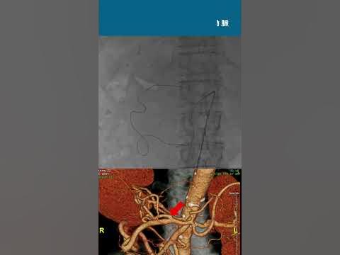 胃十二指腸動脈からの肝動脈はアプローチできる? YouTube