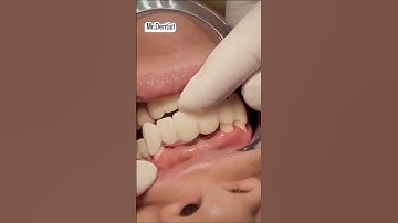 Zirconia bridge to replace missing teeth #satisfying