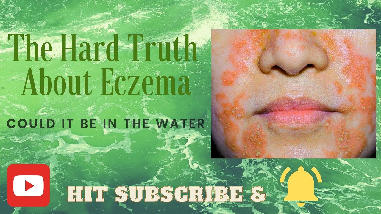The Hard Truth About Eczema [Could It Be The Hard Water?] YouTube