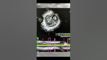 IVUS guided Complex Angioplasty to Separate origin and anomalous LAD in NSTEMI.short