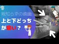 【親知らずの抜歯】 上と下どっちが痛い、腫れる、抜歯時間は？