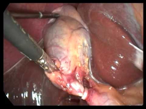Lap  Cholecystectomy Unedited 334  Chronic GB But Simple Case