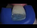 Ivoclar IPS Empress Direct Filling Composite Syringes - Enamel 3gm - 2