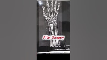 Hand radius bone fracture #fracturerecovery #shortvideo