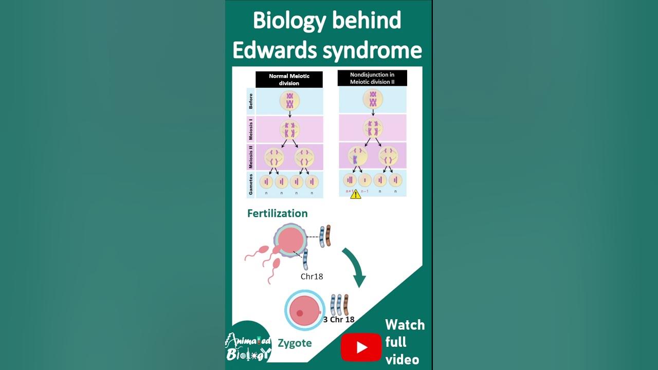 Edward syndrome pathology in 1 minute usmle YouTube