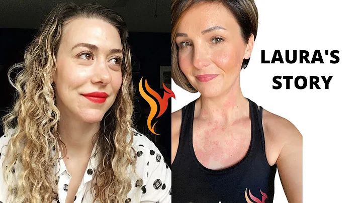 Erythrophobia, Blushing, & Social Anxiety: Laura's Story