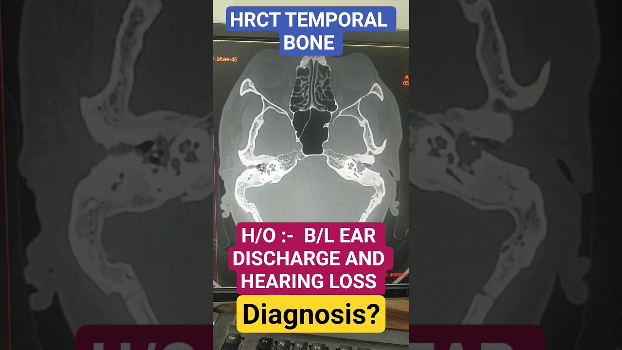 HRCT TEMPORAL BONE , DIAGNOSIS ? #radiology #diagnosis #xray #ct #science #technology