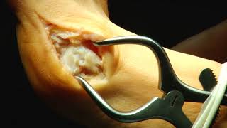 Часть 2 Операция Вальгусная Деформация Стопы. Правая Нога.