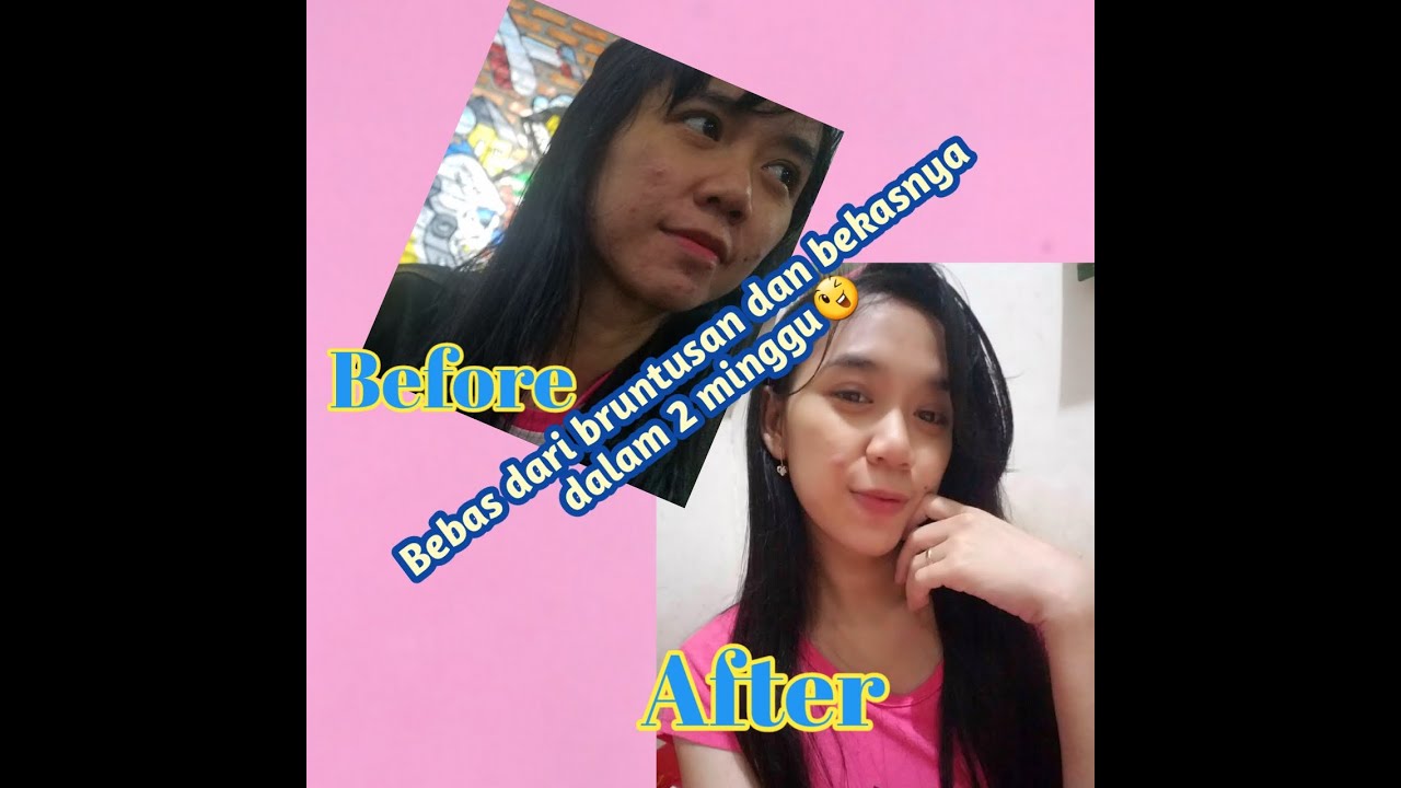 Cara cepat menghilangkan bruntusan dan bekas jerawat tidak