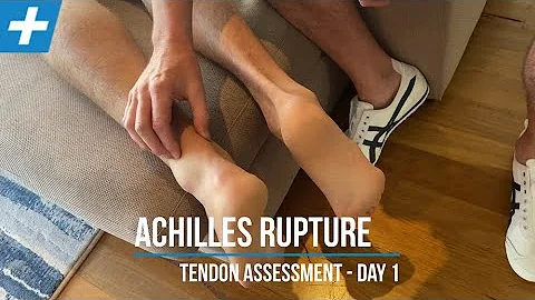 Recover from Achilles Tendon Rupture: Expert Physio Therapy