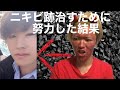 【ニキビ跡を治すダーマペンって知ってる？】ダーマペンか?レーザー治療か?【どっちもやった僕が体験談を話す】